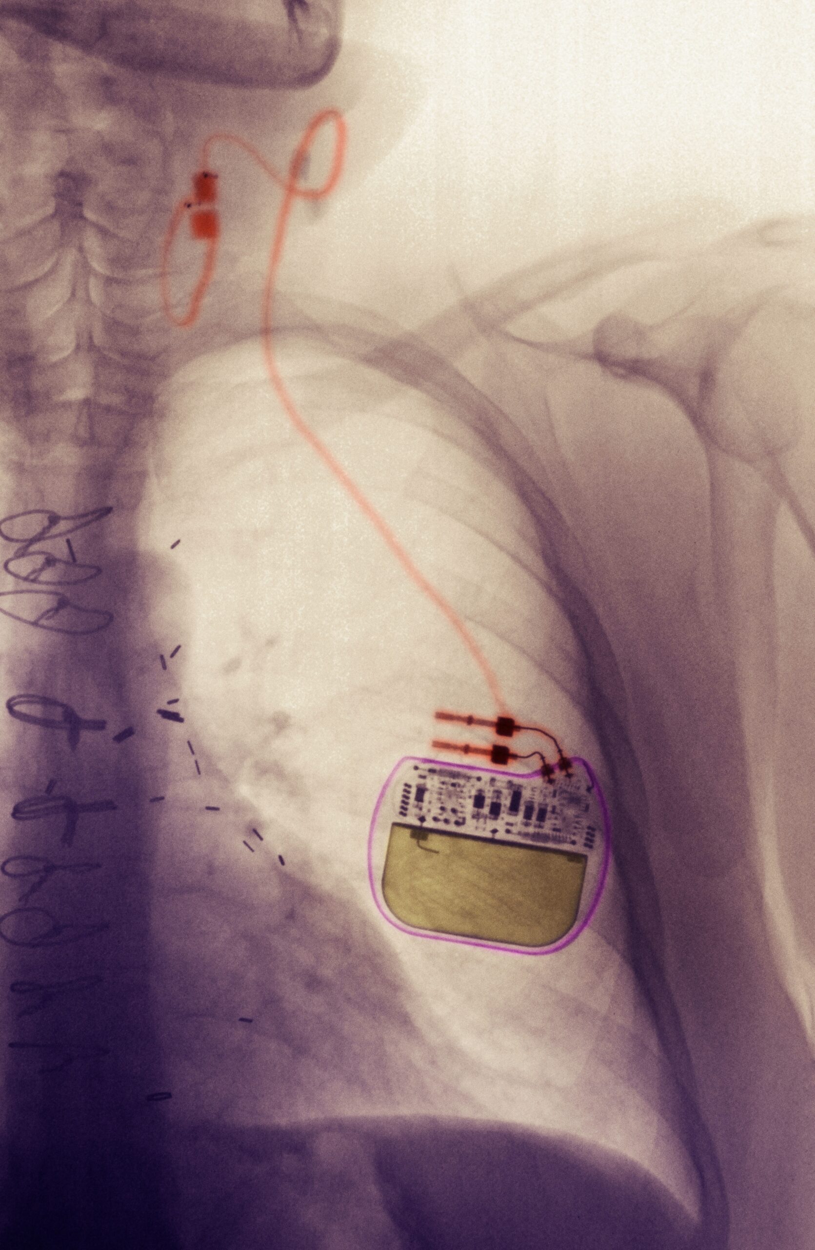 X-ray of a vagus nerve stimulation device in the chest of a patient